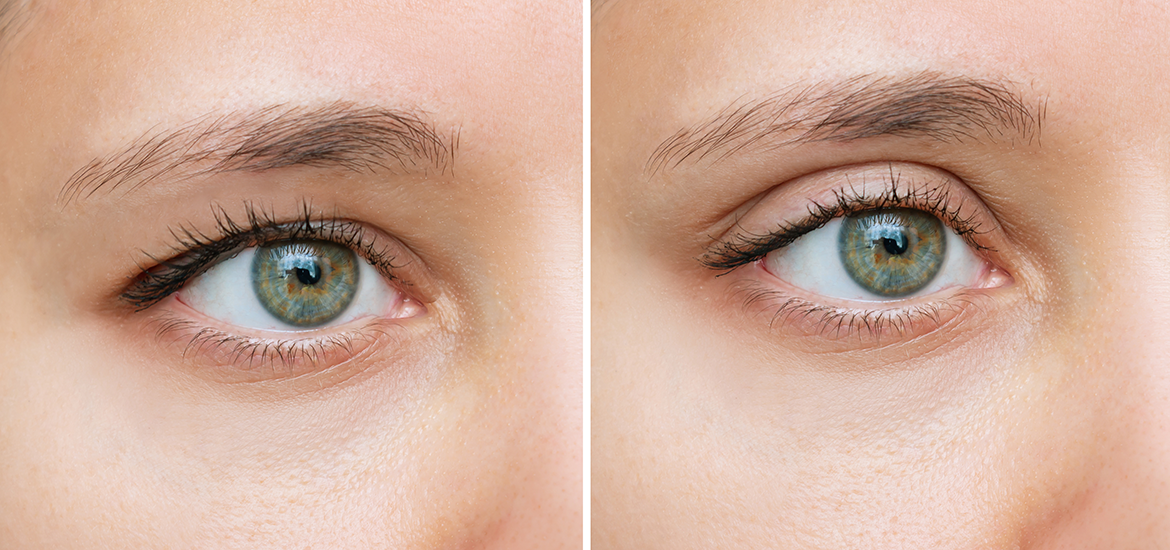 Vorher-Nachher-Bild mit und ohne Schlupflider Tapes