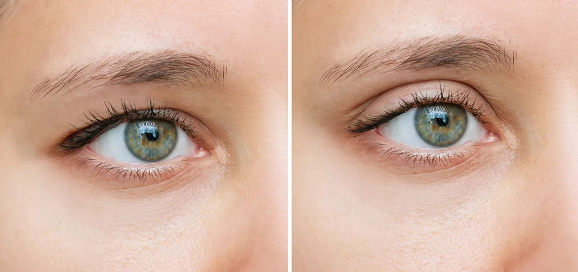 Vorher-Nachher-Bild mit und ohne Schlupflider Tapes